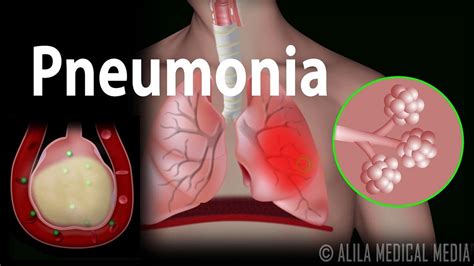 cid de pneumonia